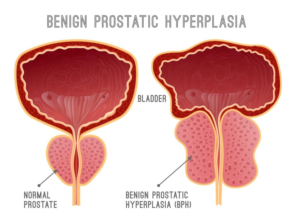 Diagram of a normal prostate vs an enlarged version caused by Benign Prostatic Hyperplasia (BPH)